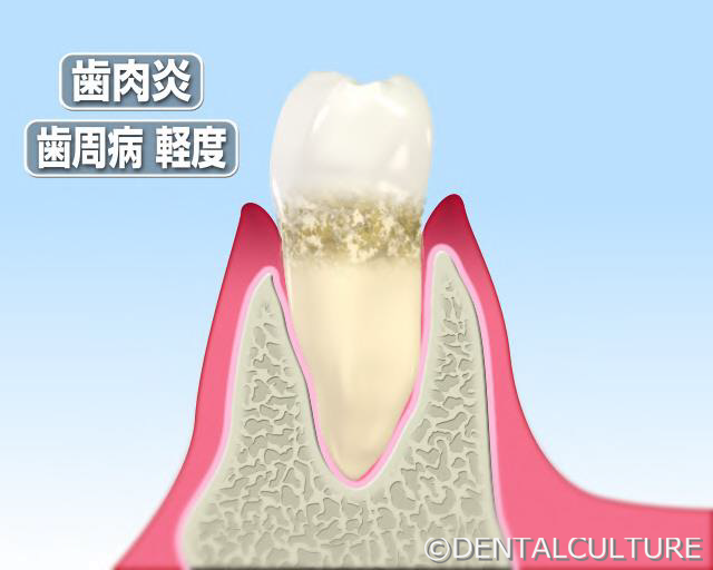 歯周病治療2